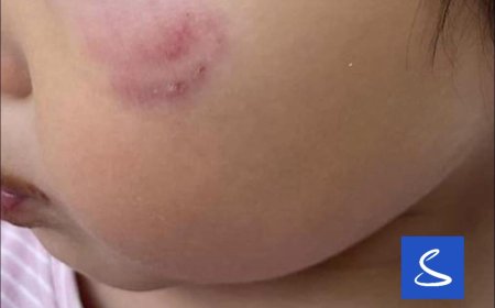 Туслах багшийн хүрэлцээгүйн улмаас 12 дугаар цэцэрлэгт явсан зарим хүүхдүүд нэгнээ бэртээж байна