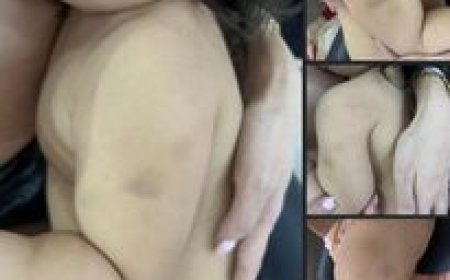 Багшдаа зодуулсан хоёр настай охин зөөлөн эдийн гэмтэл авч, тархи нь доргижээ