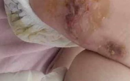 ЭХЭМҮТ-ийнхэн нярай хүүхдийн "шархыг цэвэрлэх материал байхгүй өөрөө аваад өөрөө боолт хий" гэжээ