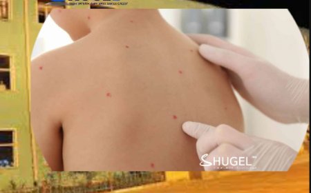 Нийслэлийн 58  дугаар сургуулийн тавдугаар ангийнхан дунд салхин цэцэг өвчны тохиолдол гарчээ