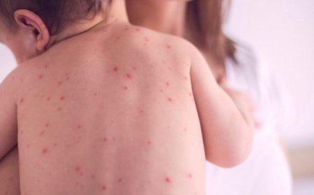 Улаанбурхан өвчний халдвар авсан хүүхдүүдийн нэг нь  хүндэрч эрчим эмчилгээний тасагт шилжжээ