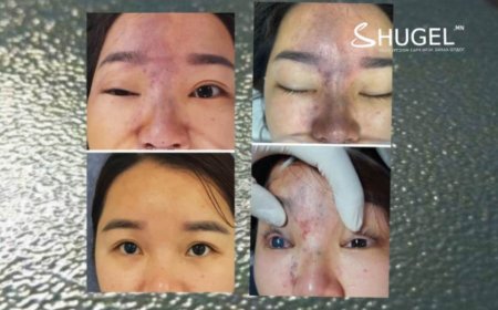 Хохирогч:  Хэн ч сохорно гэж мэдсэн бол филлер тарилгыг хийлгэхгүй